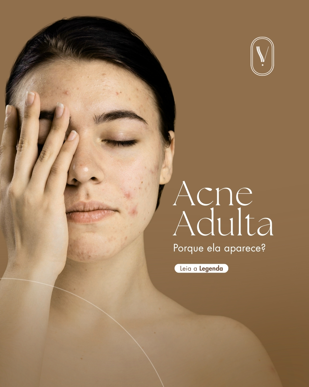 Acne adulta: por que aparece e como é tratada