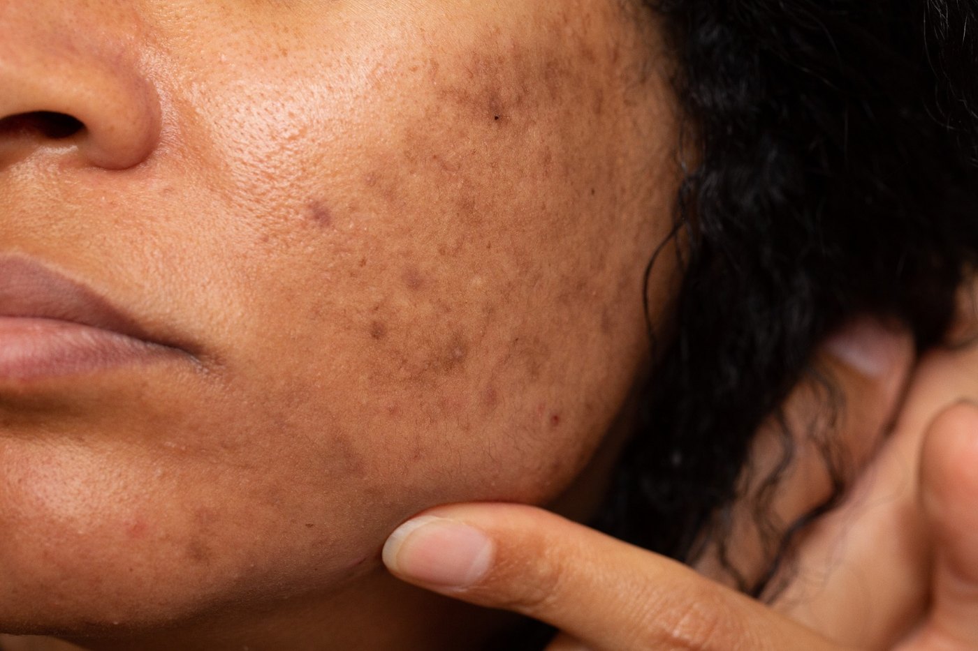 Melasma tem tratamento: alternativas para clarear e controlar